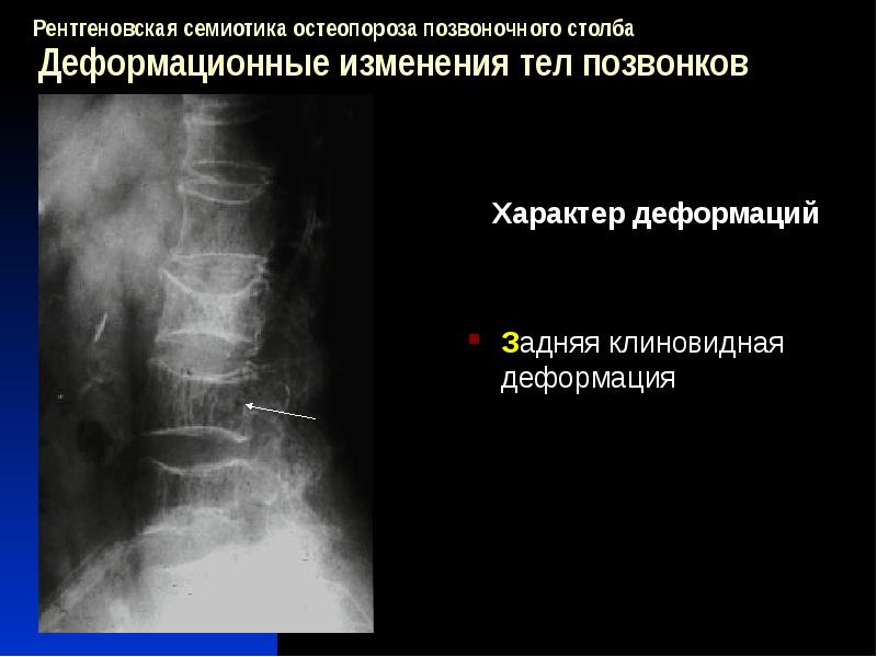 Деформация позвонков. Клиновидная деформация th7 позвонка. Клиновидная деформация тела th9 позвонка. Клиновидная деформация l1 1ст. Передняя клиновидная деформация тел позвонков th6 th7.