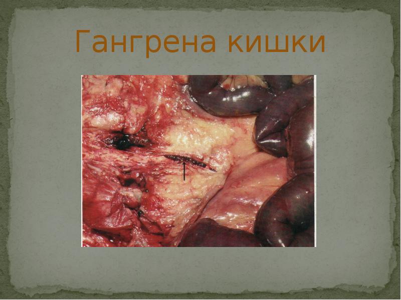 Гангрена кишки Гангрена кишки