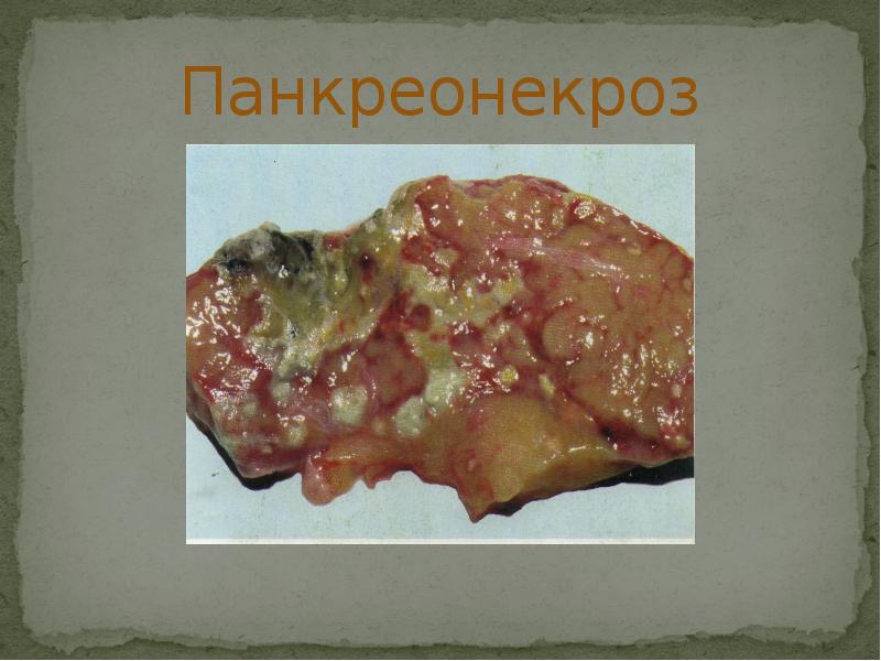 Панкреонекроз Панкреонекроз
