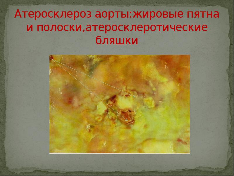 Атеросклероз аорты:жировые пятна и полоски,атеросклеротические бляшки Атеросклероз аорты:жировые пятна и полоски,атеросклеротические бляшки