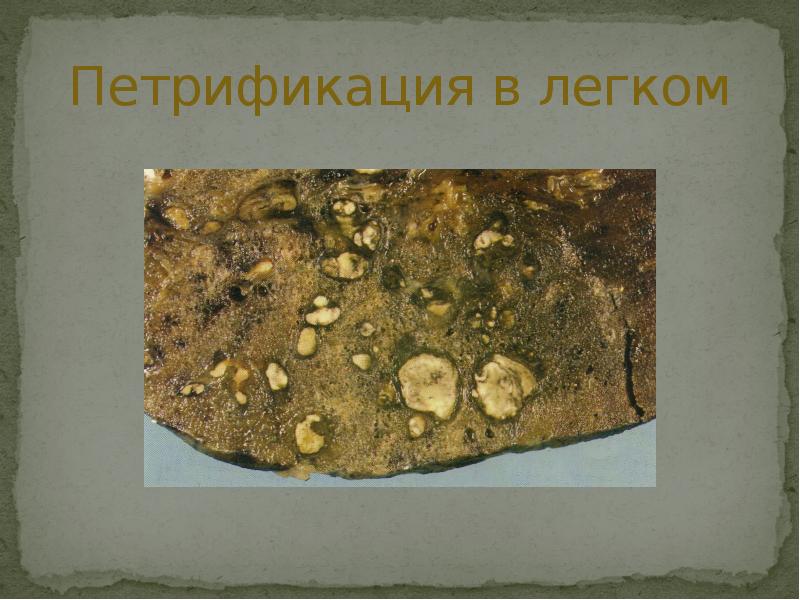 Петрификация в легком Петрификация в легком