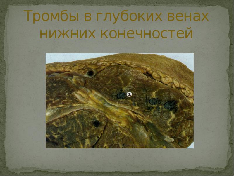 Тромбы в глубоких венах нижних конечностей Тромбы в глубоких венах нижних конечностей
