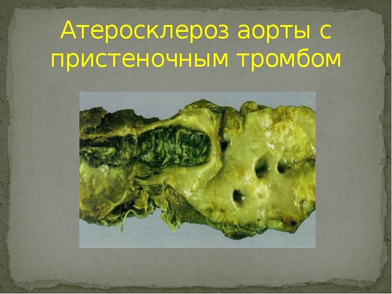 Атеросклероз аорты с пристеночным тромбом Атеросклероз аорты с пристеночным тромбом