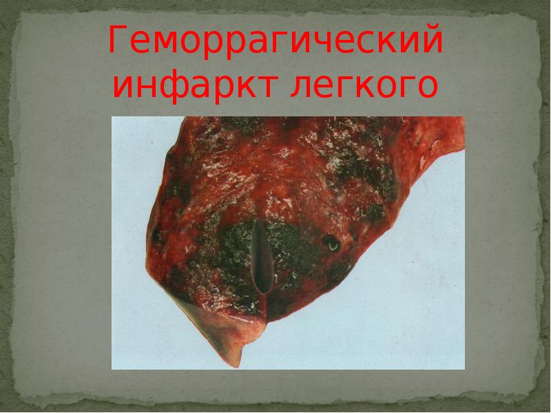 Геморрагический инфаркт легкого Геморрагический инфаркт легкого