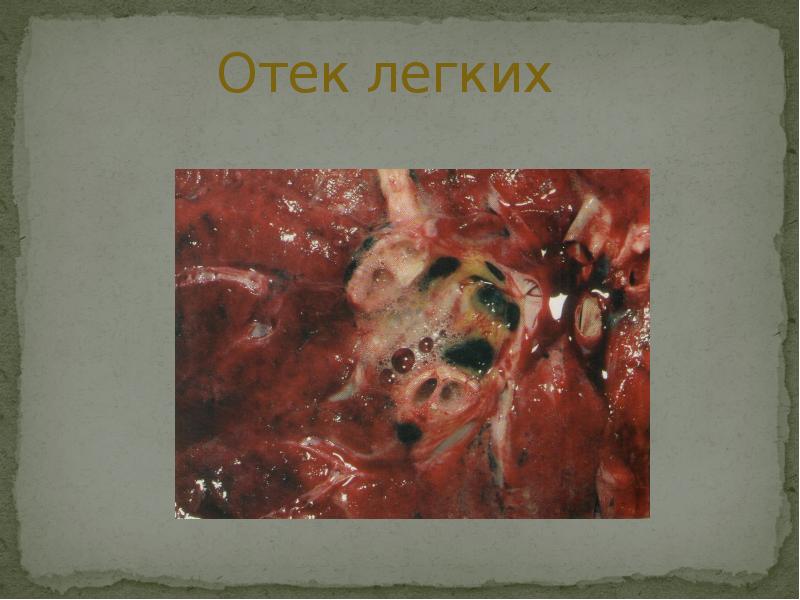Отек легких Отек легких