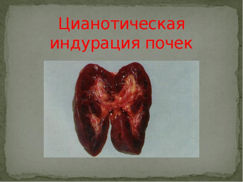 Цианотическая индурация почек Цианотическая индурация почек