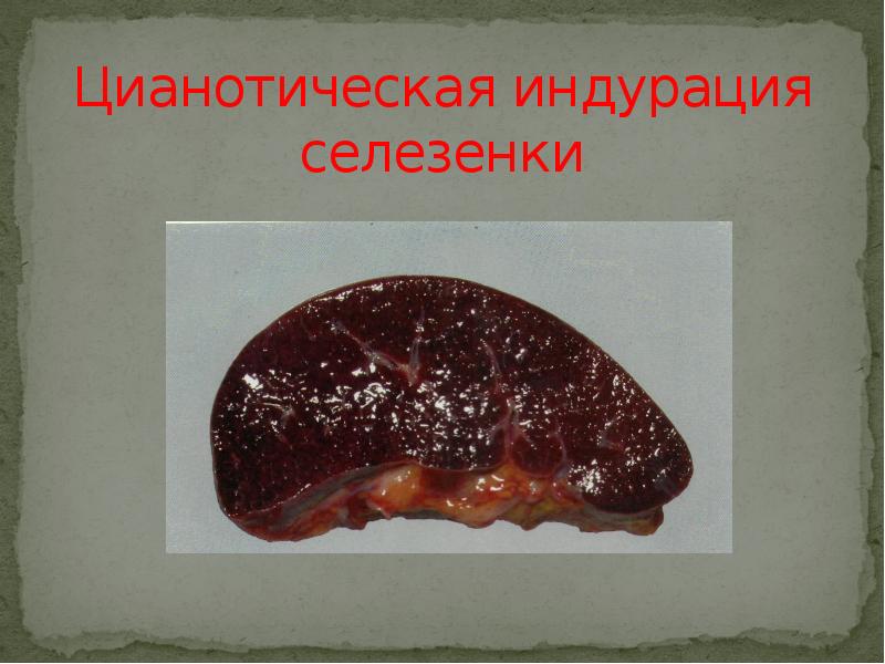 Цианотическая индурация селезенки Цианотическая индурация селезенки