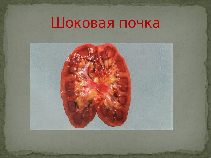 Шоковая почка Шоковая почка