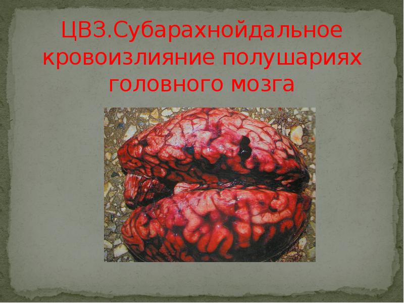 ЦВЗ.Субарахнойдальное кровоизлияние полушариях головного мозга ЦВЗ.Субарахнойдальное кровоизлияние полушариях головного мозга