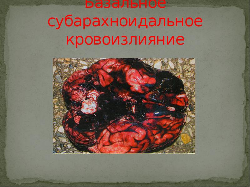 Базальное субарахноидальное кровоизлияние Базальное субарахноидальное кровоизлияние