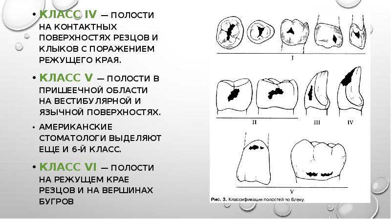 Классификация кариеса презентация