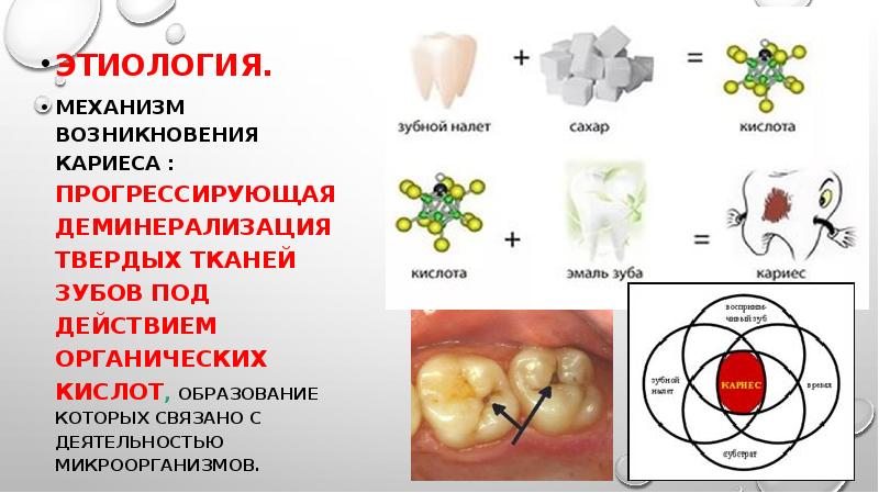 Теория возникновения кариеса презентация