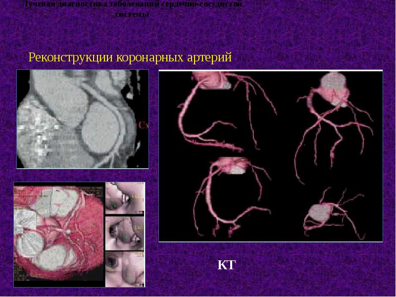 Лучевая диагностика сердечно сосудистой системы презентация