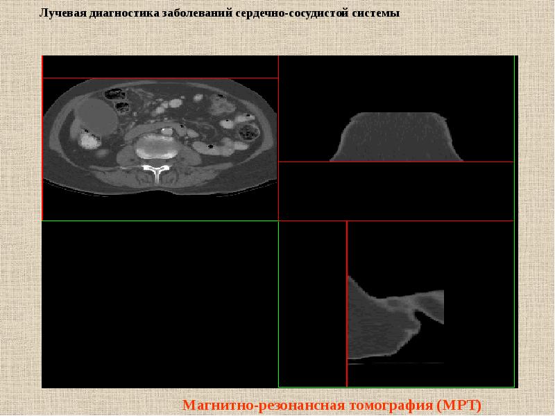 Лучевая диагностика сердечно сосудистой системы презентация