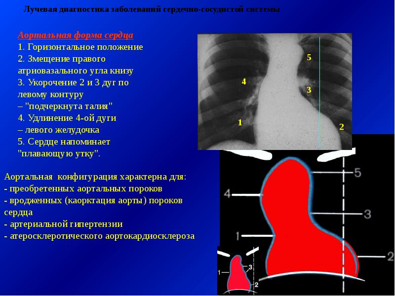 Лучевая диагностика сердечно сосудистой системы презентация