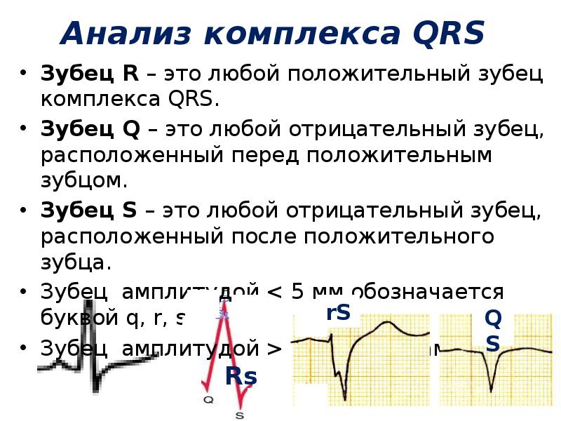 Экг со скольки. Отрицательный комплекс QRS В 3 отведении на ЭКГ. Комплекс QRS на ЭКГ W. Комплекс зубцов QRS на ЭКГ. Отрицательный комплекс QRS на ЭКГ.