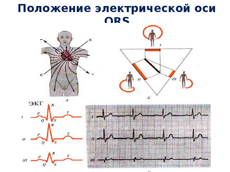 Горизонтальное экг. ЭКГ вертикальное положение электрической оси. Интерпретация ЭКГ. Вертикальная ось на ЭКГ. Электрическая ось QRS.