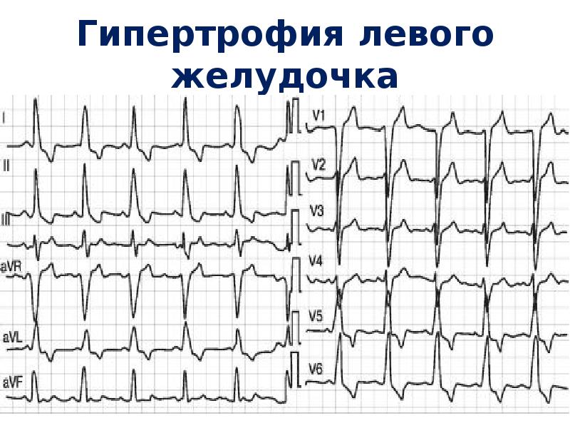 Перегрузка желудочков на экг