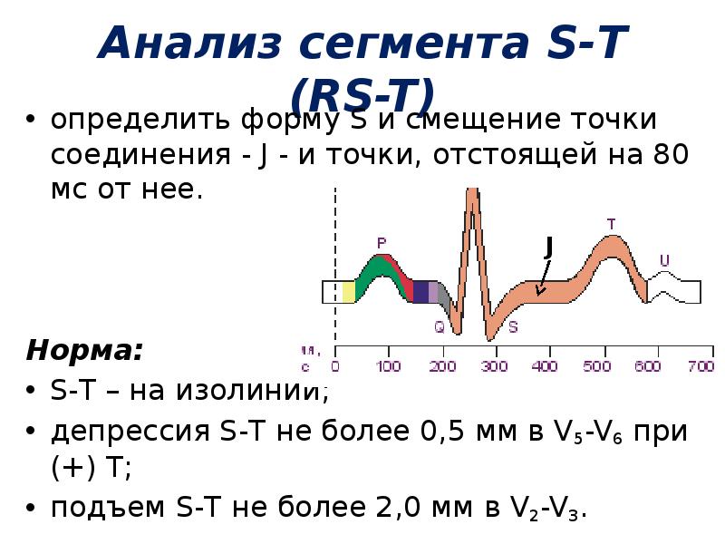Пониженные сегменты. Анализ сегмента St. Анализ сегмента St на ЭКГ. Анализ сегмента RS-T. Сегмент St на ЭКГ ниже изолинии.