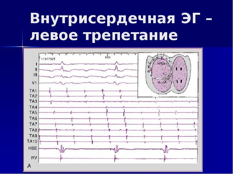 Внутрисердечный тромбоз. Внутрисердечные электрограммы. Электрограмма промоноцитов. Внутрисердечные устройства это. Ложе внутрисердечного устройства.