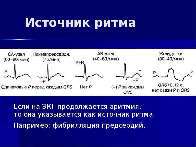 Предсердный ритм. Ускоренный эктопический предсердный ритм. Эктопическая аритмия на ЭКГ. Эктопический предсердный ритм у ребенка. Предсердный источник ритма на ЭКГ.