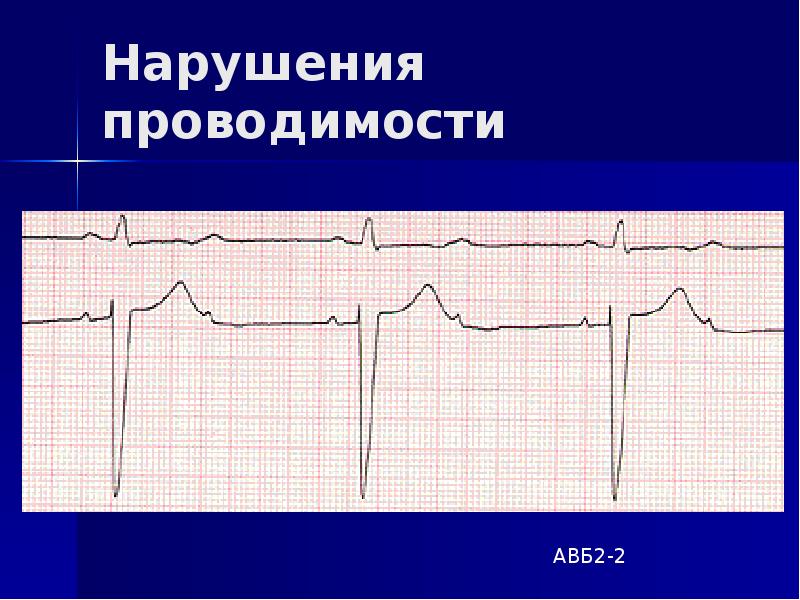 Нарушения проводимости презентация