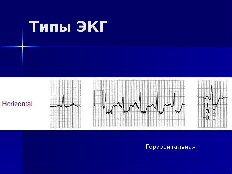 Экг горизонтальный. Разновидности ЭКГ. Типы кардиограмм. Ы Тип ЭКГ. Типы электрокардиографов.