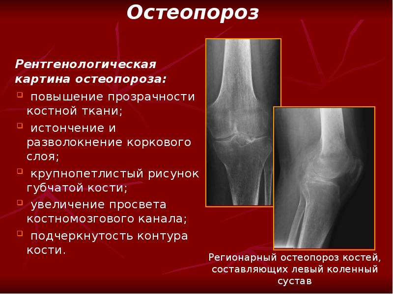 Структурные изменения костей. Остеопороз 1-2 степени тазобедренного сустава. Остеопороз коленного сустава кт. Остеопороз коленного сустава рентген. Остеопороз кости рентген признаки.
