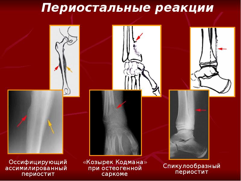 Периостальная реакция - Periosteal Reaction