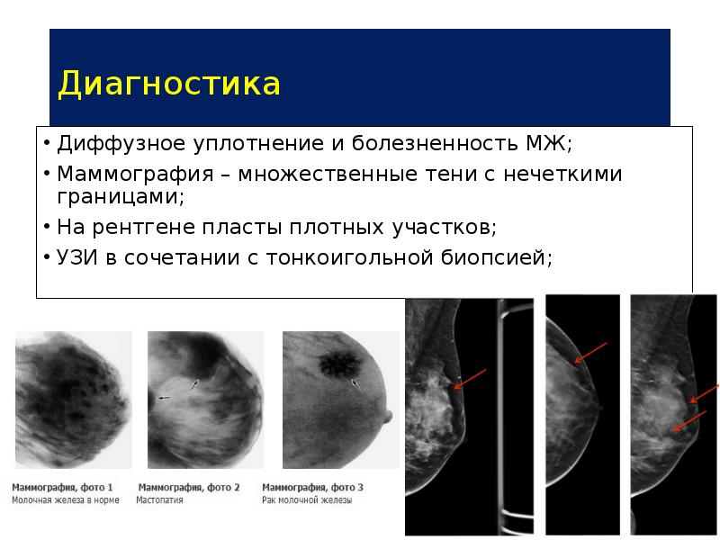 Чем отличается маммография от узи молочных желез