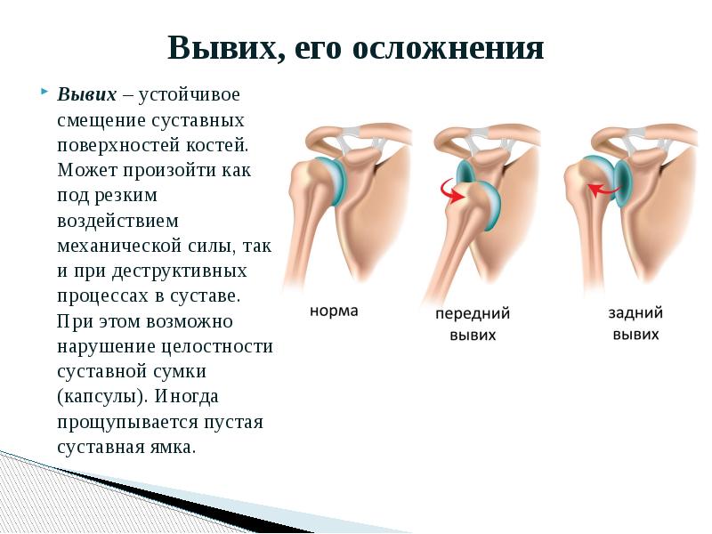 Картинка вывиха сустава