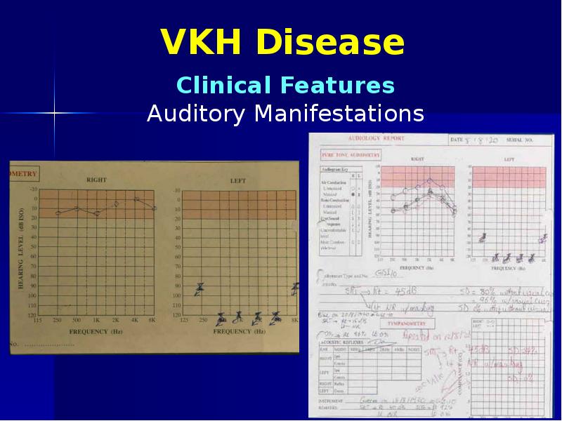 VKH Disease