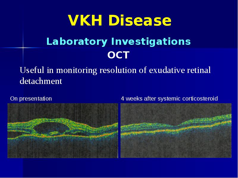 VKH Disease