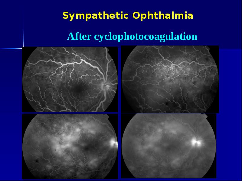 Sympathetic Ophthalmia