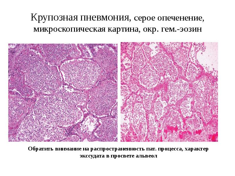 Крупозная пневмония патологическая анатомия презентация