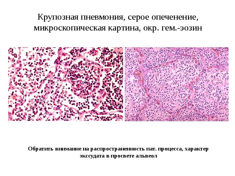 Крупозная пневмония патологическая анатомия презентация