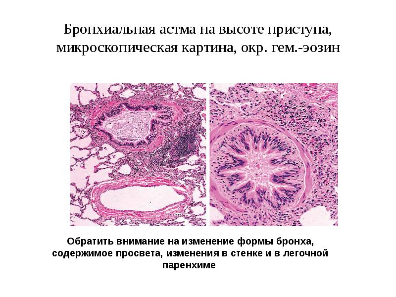 Болезни органов дыхания презентация патанатомия