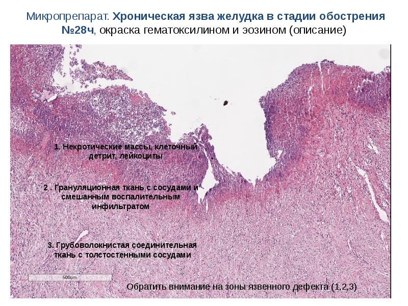 Фовеолярная гиперплазия. Хроническая язва желудка микропрепарат. Хроническая язва желудка в стадии обострения микропрепарат. Хроническая язвенная болезнь желудка микропрепарат. Язвенная болезнь желудка микропрепарат.