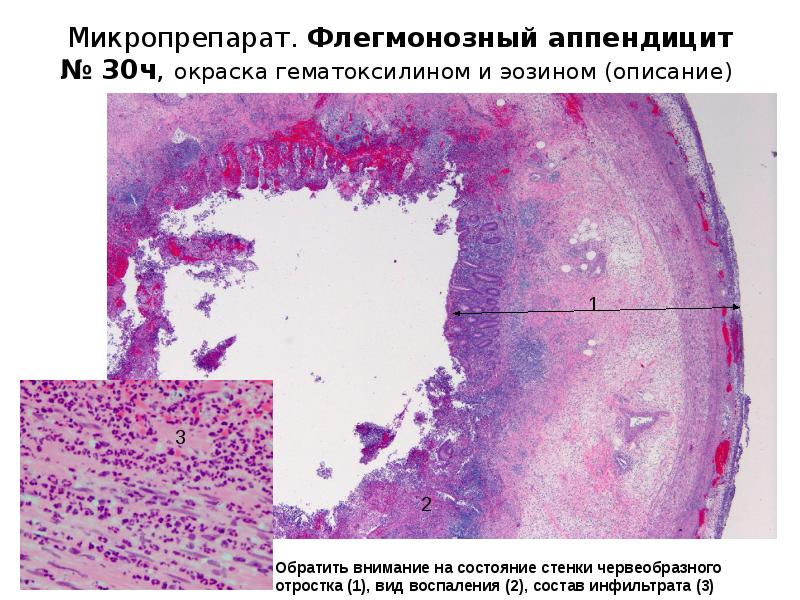 Флегмонозный аппендицит микропрепарат рисунок