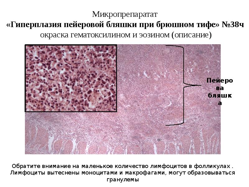 Укажите отдел пищеварительной системы имеющий в своих стенках пейеровы бляшки