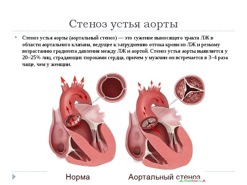 Пороки аортального клапана презентация