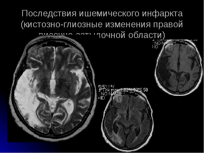 Глиозные изменения белого вещества головного мозга