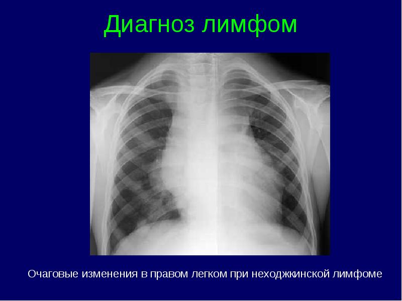 Лимфопролиферативный синдром презентация