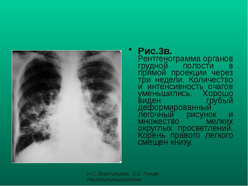 Рис.3в. Рентгенограмма органов грудной полости в прямой проекции через три недели. Рис.3в. Рентгенограмма органов грудной полости в прямой проекции через три недели.