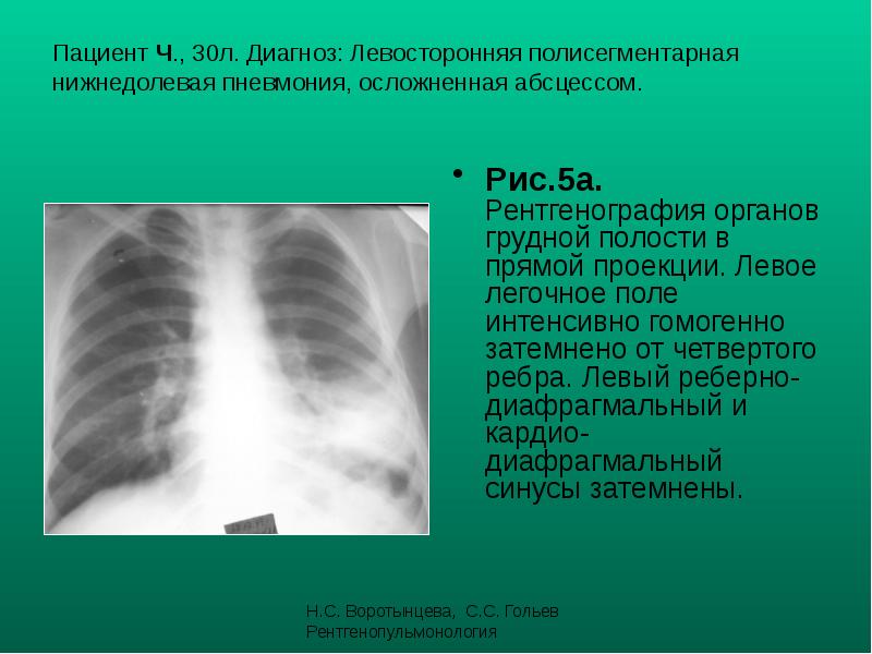 Пациент Ч., 30л. Диагноз: Левосторонняя полисегментарная нижнедолевая пневмония, осложненная абсцессом.
Пациент Ч., 30л. Диагноз: Левосторонняя полисегментарная нижнедолевая пневмония, осложненная абсцессом.