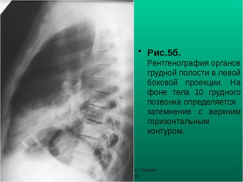 Рис.5б. Рентгенография органов грудной полости в левой боковой проекции. На фоне Рис.5б. Рентгенография органов грудной полости в левой боковой проекции. На фоне