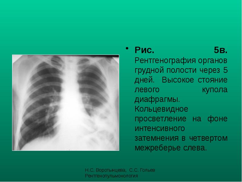 Рис. 5в. Рентгенография органов грудной полости через 5 дней. Высокое стояние Рис. 5в. Рентгенография органов грудной полости через 5 дней. Высокое стояние