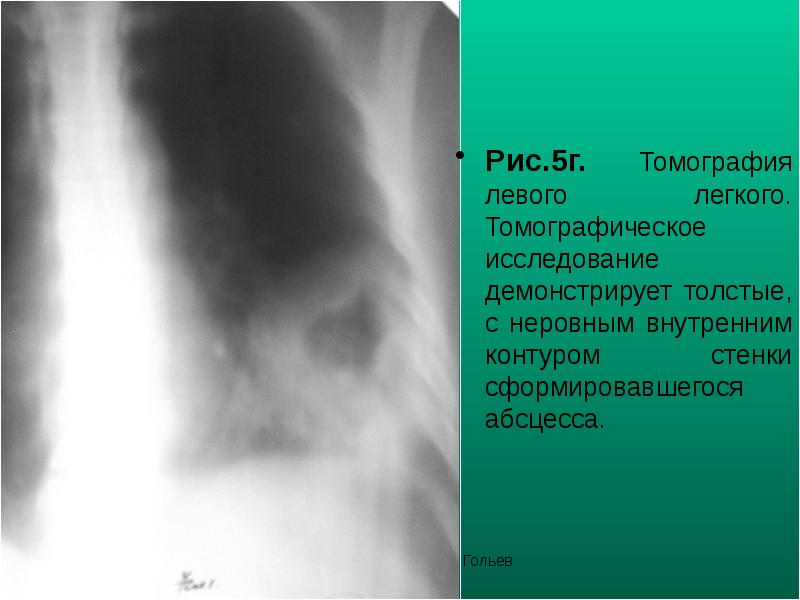 Рис.5г. Томография левого легкого. Томографическое исследование демонстрирует толстые, с неровным внутренним Рис.5г. Томография левого легкого. Томографическое исследование демонстрирует толстые, с неровным внутренним