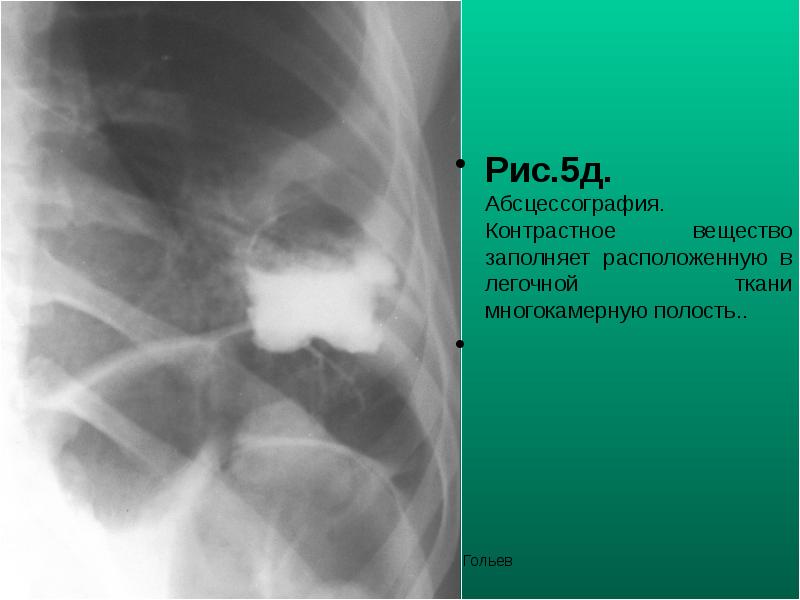 Рис.5д. Абсцессография. Контрастное вещество заполняет расположенную в легочной ткани многокамерную полость..
Рис.5д. Абсцессография. Контрастное вещество заполняет расположенную в легочной ткани многокамерную полость..