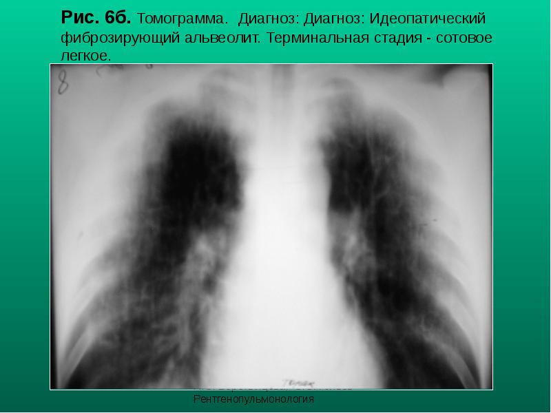 Рис. 6б. Томограмма. Диагноз: Диагноз: Идеопатический фиброзирующий альвеолит. Терминальная стадия - Рис. 6б. Томограмма. Диагноз: Диагноз: Идеопатический фиброзирующий альвеолит. Терминальная стадия -